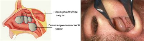 Полипоз носа - признаки, симптомы, лечение и фото