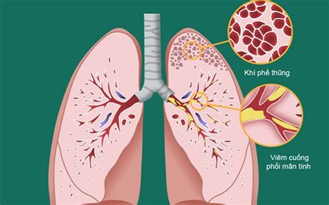 Bệnh phổi tắc nghẽn mãn tính giai đoạn 2: Dấu hiệu nhận biết và cách ...