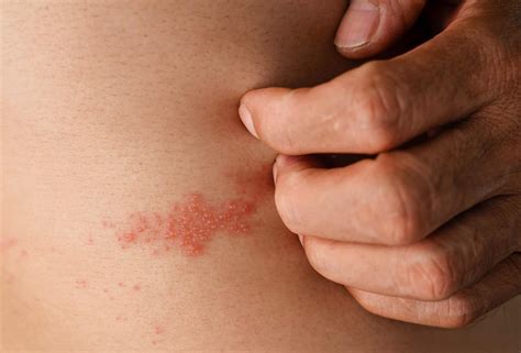 Asthma and Shingles