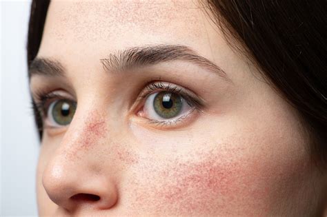 Rhinophyma treatment, prevention strategies