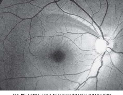 Figure 20 from Clinical Evaluation of Optic Nerve Head in Glaucoma | Semantic Scholar