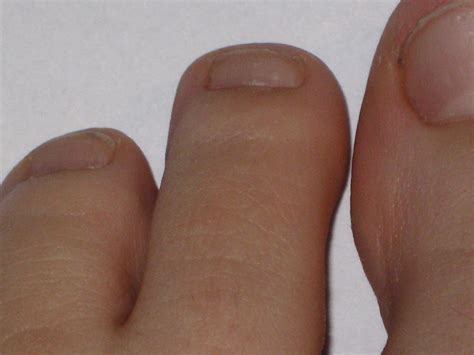 Toenail Troubles: Unraveling the Enigma of Ingrown Nails – The Oxford