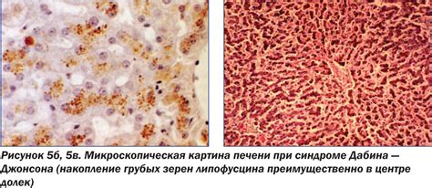 Доброкачественные гипербилирубинемии: всегда ли они абсолютно ...