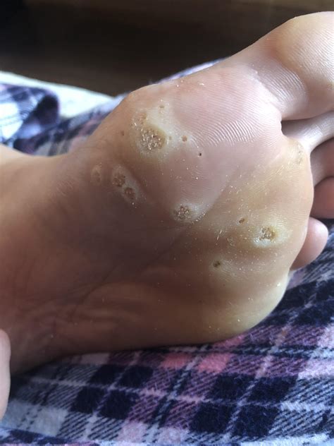 Planters Warts taking over. Changing tape shaving down enjoy