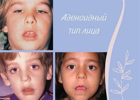 ⚪ Почему дышать ртом опасно Нарушение носового дыхания приводит к ...
