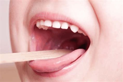 how long does it take to heal from tonsil removal