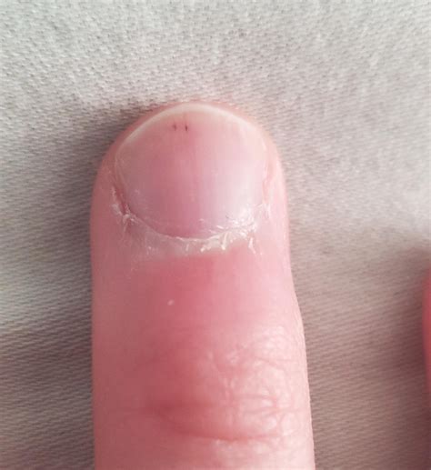 What Causes Black Dots Under Fingernails at Melinda Morris blog