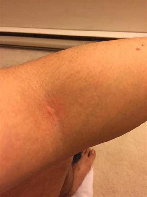 I got bitten by something while sleeping and woke up with sharp chest