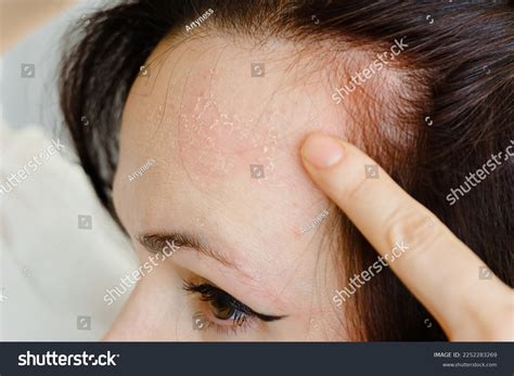 52 Chemical Peeling Before After Images, Stock Photos & Vectors ...