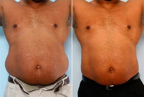 love handle liposuction  latest advances  body contouring gsahist