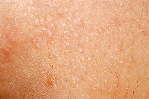 Allergic Reaction Face Pustules at Eugene Head blog