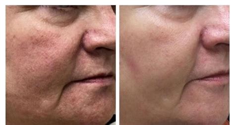 Before & After Gallery – Cincinnati NeoGen Plasma Skin Regeneration