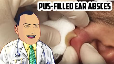 pus filled ear abscess drained revisited popping youtube