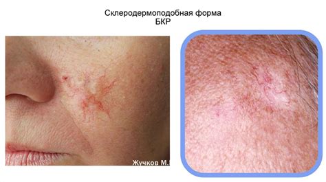 Базальноклеточный рак кожи. Диагностика и лечение - презентация онлайн