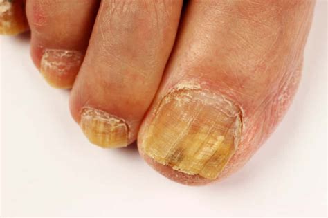 Définition | Onychomycose - Mycose des ongles - Mycose unguéale