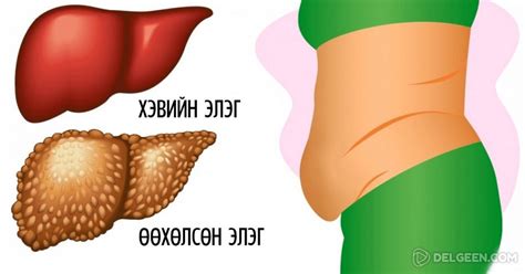 Элэг хордсон үед хүний биед илрэх 6 шинж тэмдэг. Танд эдгээр зүйлс ...