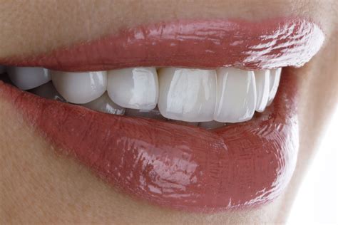 porcelain teeth veneers benefits process cost  care teeth