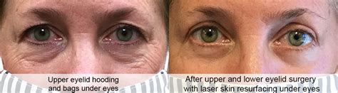 Blepharoplasty Surgeons Orange County CA | (714) 449-1940