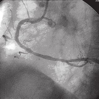 Coronary angiogram shows the right coronary artery at baseline ...