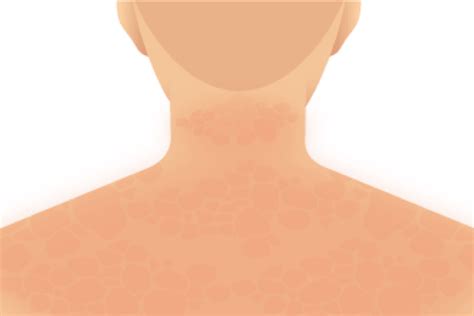 Dermatomyositis signs, symptoms: muscle inflammation & rash