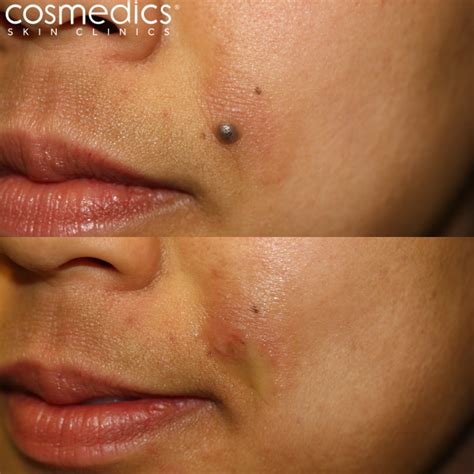 Facial Mole Removal Success Story | Cosmedics Skin Clinics