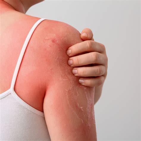 13 Effective Natural Sunburn Relief Methods to Try this Summer ...