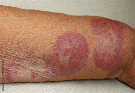 granuloma annulare  rare skin disease   arm   patient stock