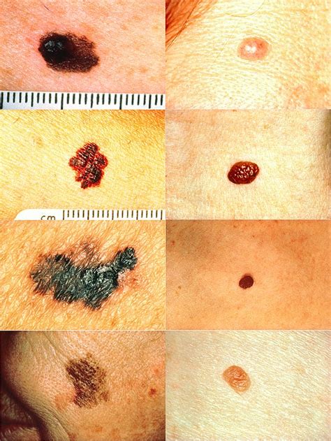 Melanoma - Wikipedia