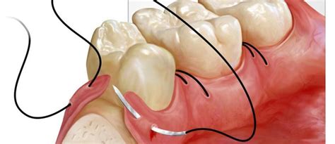 suturing techniques  dentistry