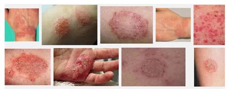 Eczema - MedTour
