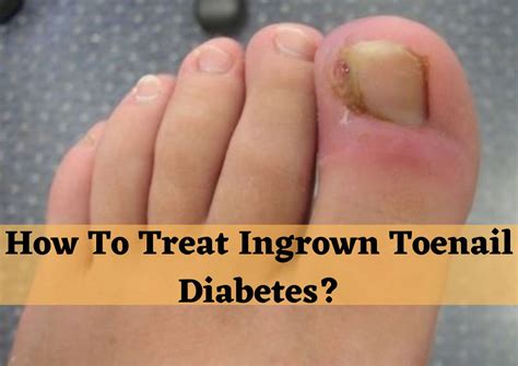 How To Treat Ingrown Toenail Diabetes?