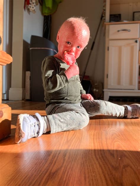 Ichthyosis