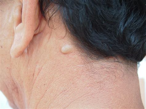 mengobati kista epidermoid penyebab  gejalanya