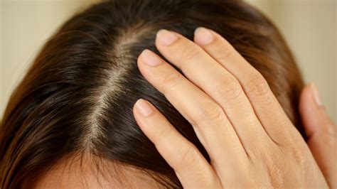 Dandruff Vs Dry Scalp - How To Recognize And Heal Both?