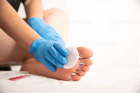 Treatment of a callus on the foot with a special solution after surgery