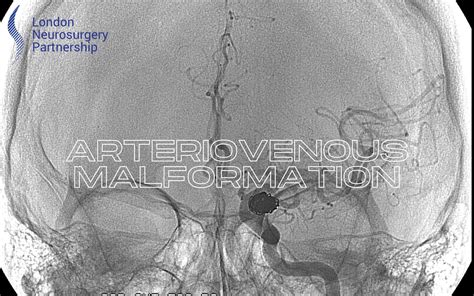 Arteriovenous malformation - London Neurosurgery Partnership