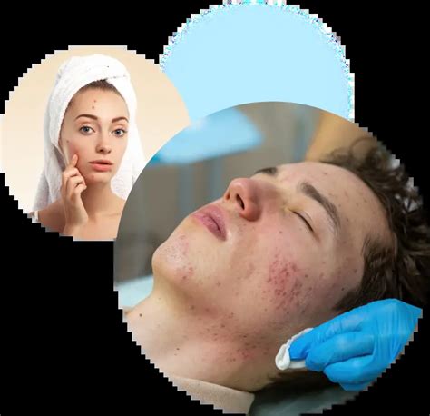 Acne Scar Treatment in Dubai | Acne Scar Removal in Dubai