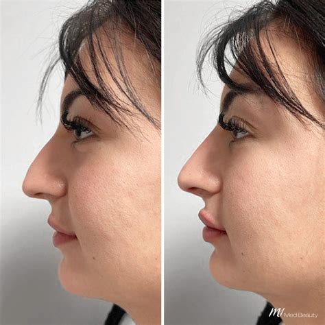 Before and After treatment pictures - M1 Med Beauty BG