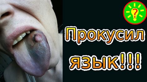 Прокусил язык! что делать? - YouTube