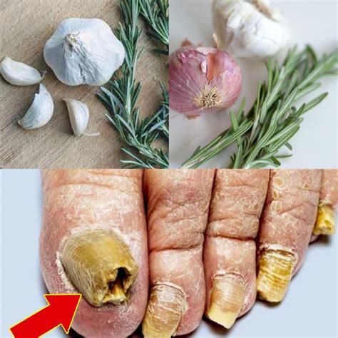 nail fungus home remedies 1