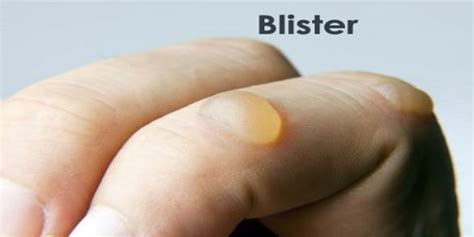 blister assignment point