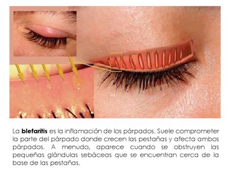 Blefaritis | PDF