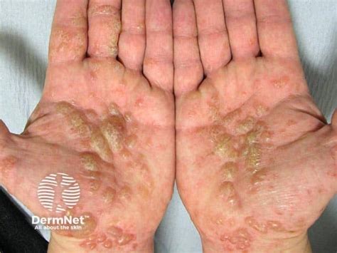 eczema blisters  hands