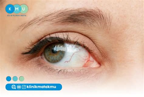 penyakit  iris mata jenis gejala hingga pengobatan