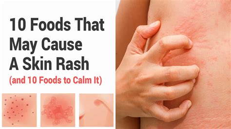 Which of the following diseases causes a skin rash Resolve | abouthairloss