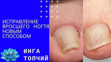 Вросший ноготь. Лечение вросшего ногтя новый способ. - YouTube