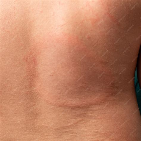 Premium Photo | Annular erythema on the back of a child, Lyme disease.