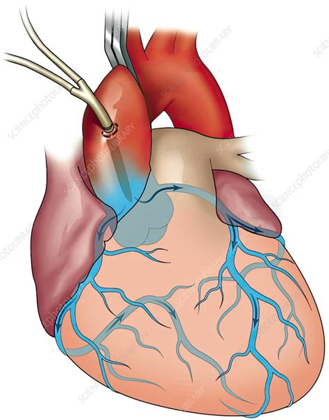 cardiac angiogram illustration stock image  science