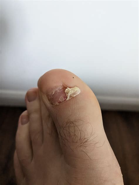 Thought you all might appreciate this, had a full nail removal a while