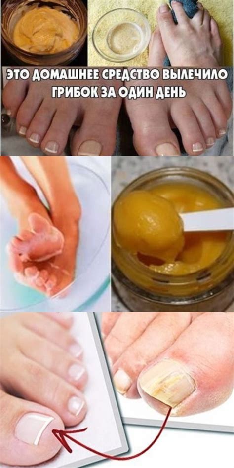 Best 8 ЭТО ДОМАШНЕЕ СРЕДСТВО ВЫЛЕЧИЛО ГРИБОК ЗА ОДИН ДЕНЬ | Natural ...